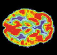 PET/MRI scan
